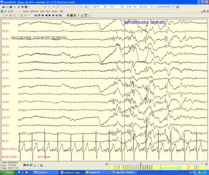 I.4. Kamaszkori és felnőttkori elektroklinikai szindrómák Juvenile myoclonic epilepsy (JME) Prevalencia: az összes epilepszia 2.8-5.4%-a.