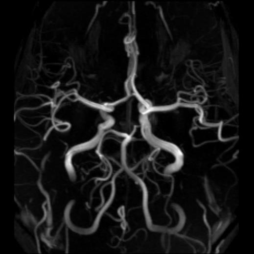 I.4. Kamaszkori és felnőttkori elektroklinikai szindrómák Epilepsy with generalized tonic clonic seizures alone 90.03.01.