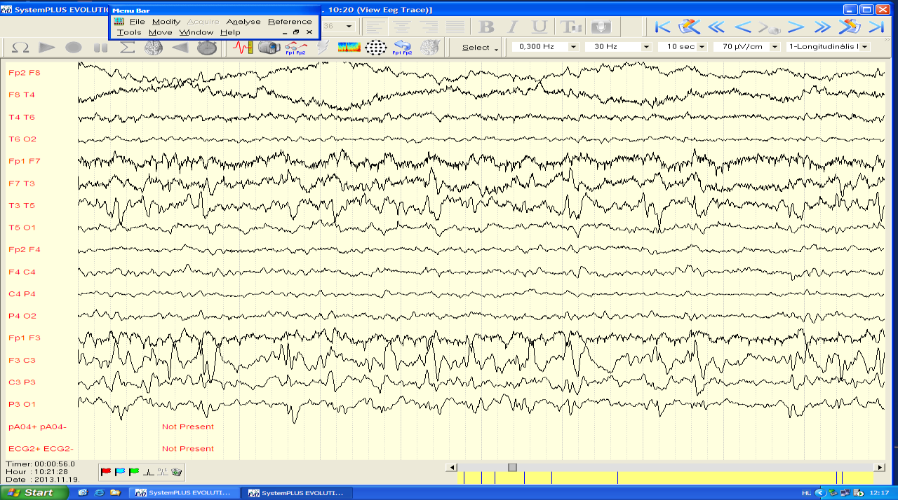 SE noncunvulzív SE dgn. felállításában kulcsszerepe van az EEG-nek 1, Elhúzódó/tartós tudatzavarral járó állapotok diagnosztikájának és nyomon követésének célszerű eszköze az EEG.