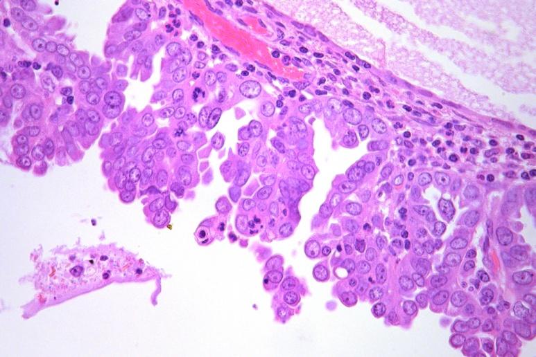 Endometrialis intraepithelialis carcinoma Csak a felszínt és a felszínes mirigyeket érinti Serosus carcinoma non-invazív variáns (vagy terjedési mintázat).