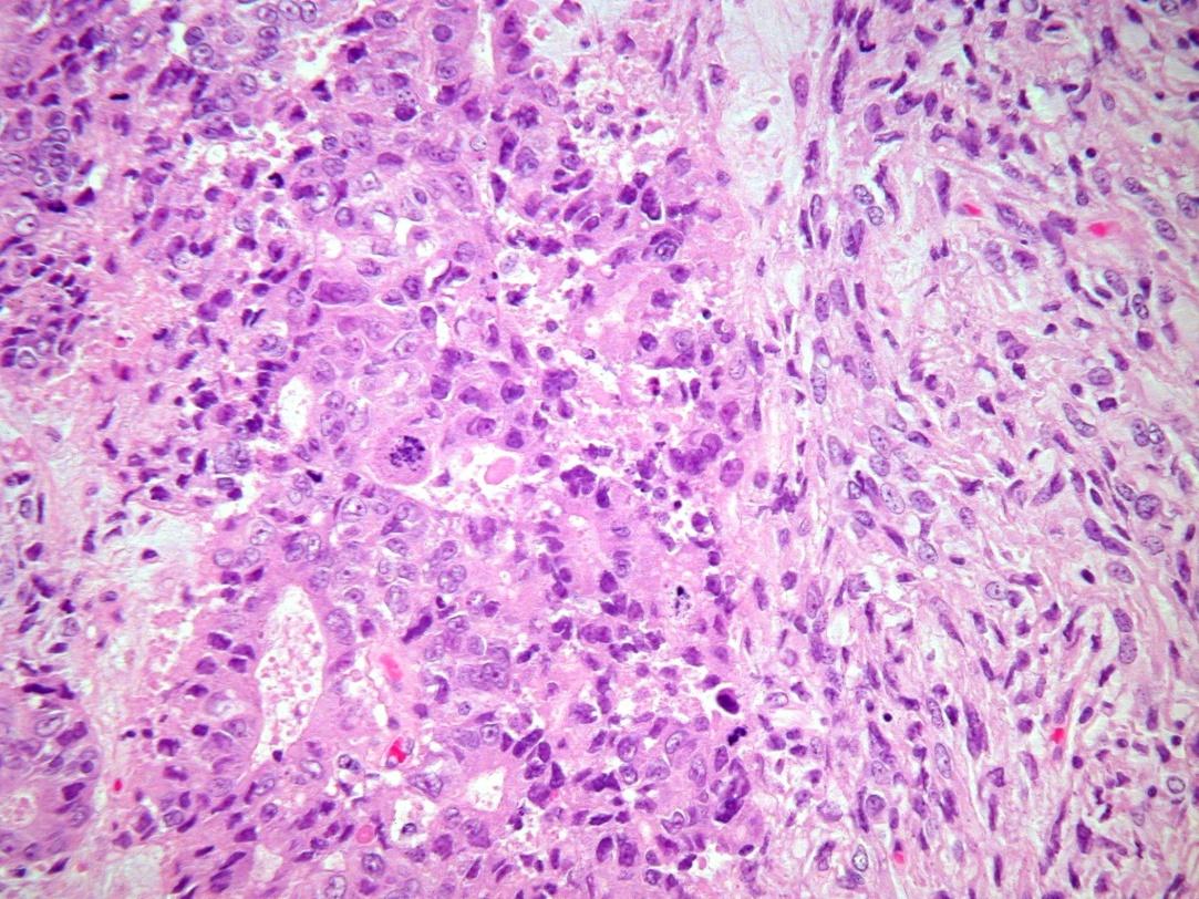 Carcinosarcoma (MMMT) Endometrioid carcinoma orsósejtes elemekkel low grade orsósejtes komponens Grade 3 EC vagy SC lehet fokális high-grade EMT a polypoid részeken (kisebb mint 1 mm) nem MMMT