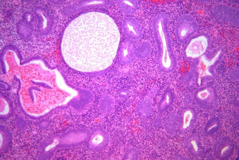 Simplex hyperplasia Diffúz elváltozás Endometrium térfogata megnő Mirigyek: változatosak, cisztikus formák Stróma: aktív Differenciáldiagnózis Zavart proliferáció fokális Cisztikus atrófia: nyugvó
