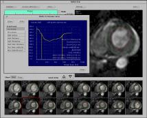 3.3.3.2. A felvételek értékelése A MASS 4.0 program az MRI vizsgálattal kapott DICOM formátumú képanyag kezelésére alkalmas.