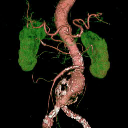 Subrenal AAA CTA