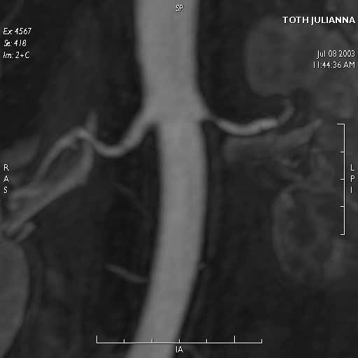 stenosis