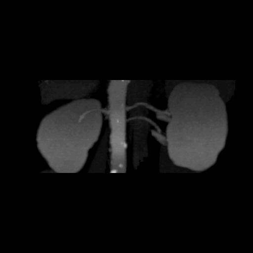 Multiple renal arteries CTA