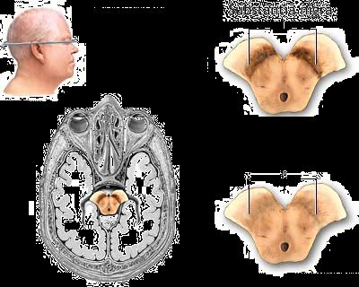 Parkinson kór 35 Dopamin hipotézis Normál agy Parkinsonos