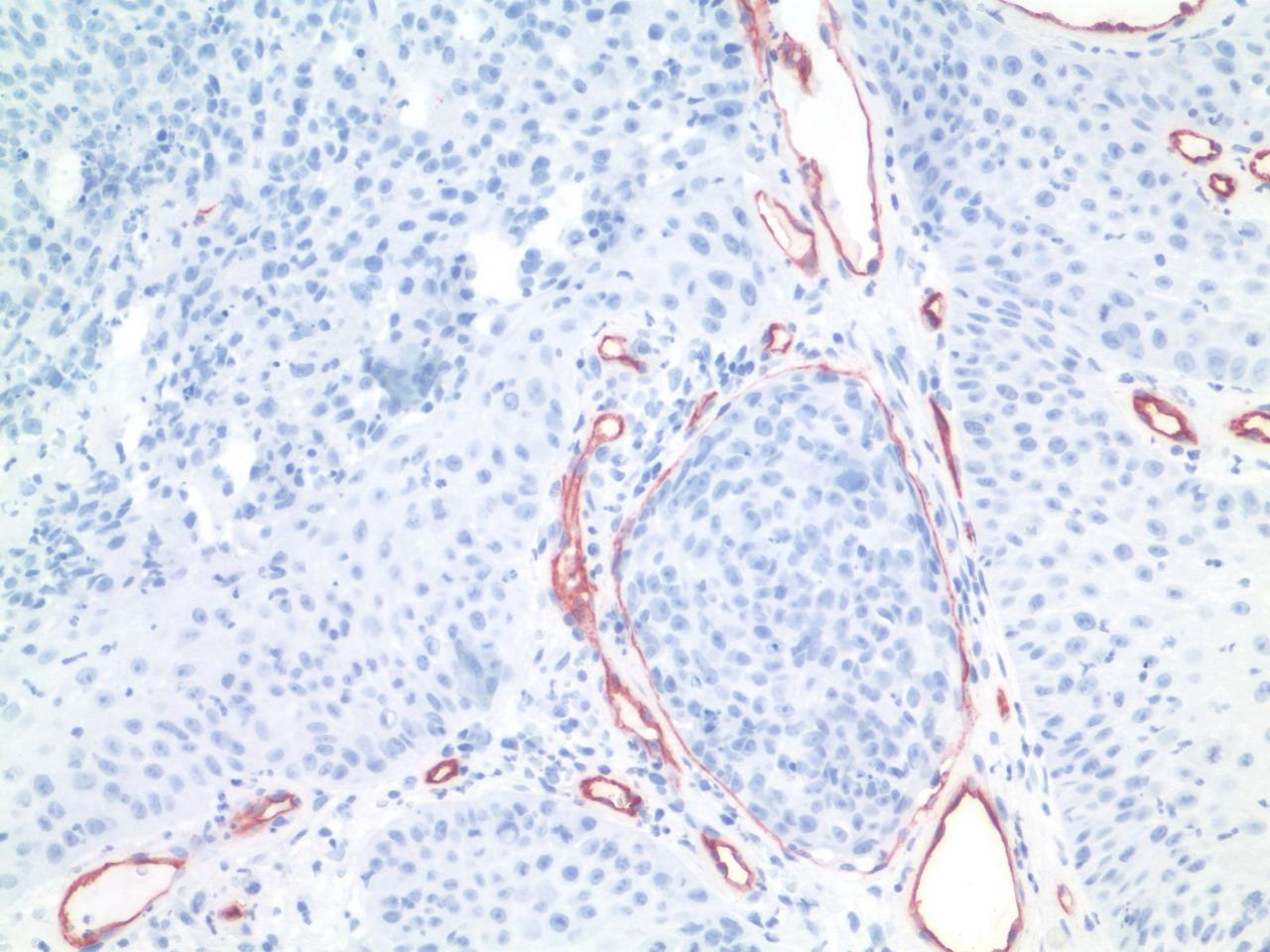 Vasculáris invázió Perineurális és vascularis invázió jelentősen