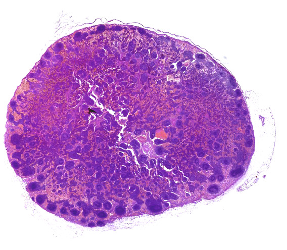 Pancytokeratin hámmarker Micrometastasis a sentinel nyirokcsomó nyirokcsomóban - Az ún.