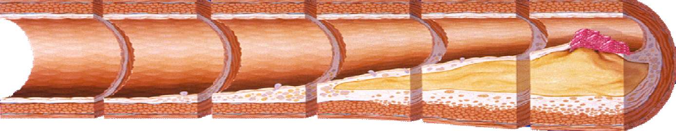 Hypertonia előtti állapot Hypertonia + vascularis károsodás Hypertonia + klinikai érbetegség CV rizikó Rizikófaktorok Célszerv- károsodások Gyógyszerek száma Vascularis események RR, DM, Chol,