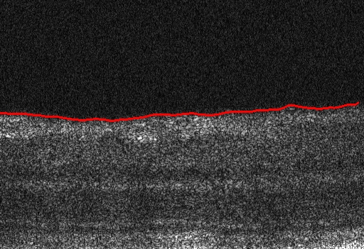 Az Internal Lmtng Membrane (ILM) szegmentácója A Retnal Pgment Epthelun (RPE) szegmentácója IV.6.