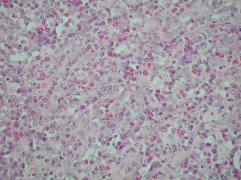 Idült eosinophil sejtes