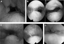 Sleep endoscopia I.