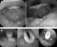 Sleep endoscopia IV.