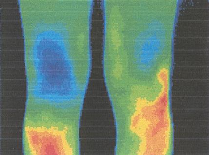 4. kép: A két térd thermographiás képe a relapsus kezdetén A két hónappal később készült felvételen (5.