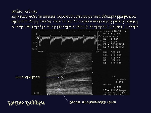 Transducer típusok Elkész szített UH képk Az UH kép k p a szervezet belsejébõl l származ rmazó hangreflexiókat megjelenítõ,, nagy teljesítm tményû számítógéppel összerakott visszhang-kép (ezt