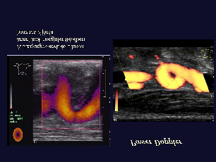 Color doppler Power doppler Az Ultrahang vizsgálatok elõnyei Nem használunk ionizáló sugárz rzást Korlátlanul ismételhet telhetõ Jó elérhet rhetõség, hozzáférhet rhetõség Relatíve rövid r várakozv