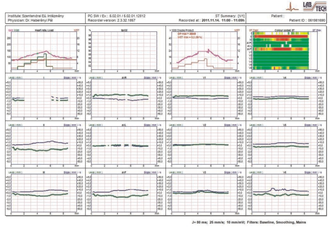 TERHELÉSES EKG RENDSZEREK TERHELÉSES EKG RENDSZEREK EC-12S PC alapú nyugalmi és terheléses rendszer beépített vérnyomásmérővel (Bluetooth) - BEÉPÍTETT KIÉRTÉKELŐ RENDSZER A PONTOS DIAGNÓZISHOZ - KIS