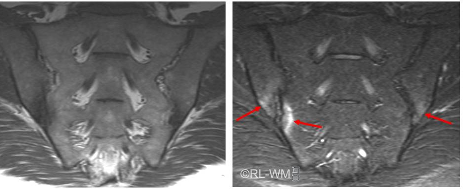 SpA okozta rendellenességek az SIízületben: csontvelőödéma T1SE STIR A csontvelőödéma (BME) definíciója: az SI-ízület csontvelőjének szignálja megerősödik a STIR felvételeken; a
