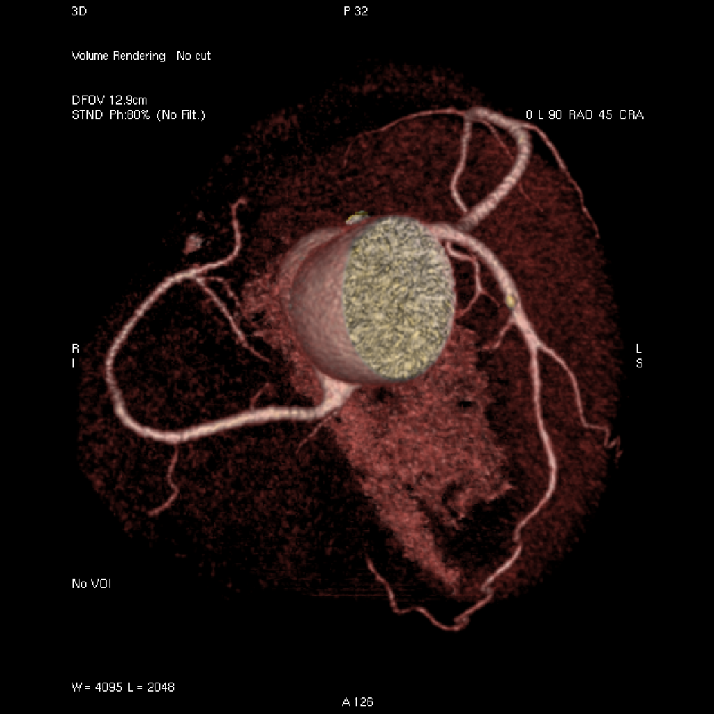 Koronária CT-angiográfia