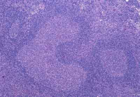 A PTLD WHO-szerinti beosztása I. Korai elváltozások (Early lesions): 1. Reaktív plazmasejtes hyperplasia (diffúz B- sejtes hyperplasia). 2. Mononucleosis infectiosa 3.