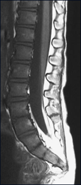 Diastematomyelia B/B. Zárt dysraphismusok subcutan massza nélkül: Caudalis regressziós szindróma 1. és 2. típus Többszörös thoracalis szegmentációs zavar és diastematomyelia Miről esett szó?