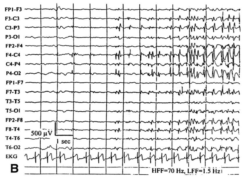 1 H MRS, FDG PET, EEG temporalis lebeny epilepsiában Ictalis