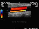 Duplex carotis és vertebralis artéria ultrahang