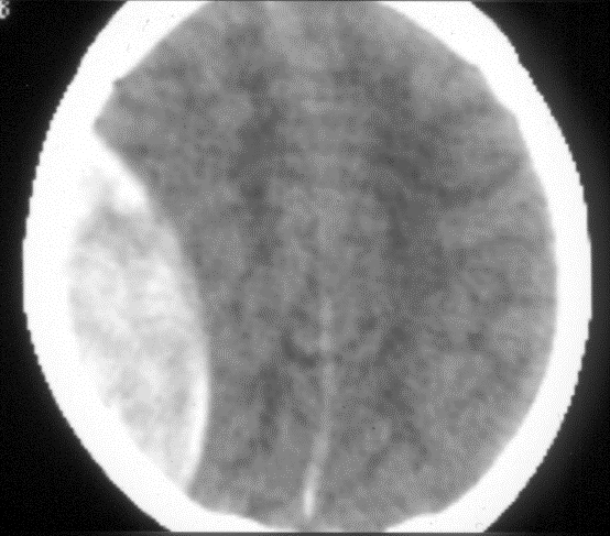 Epidurális haematoma