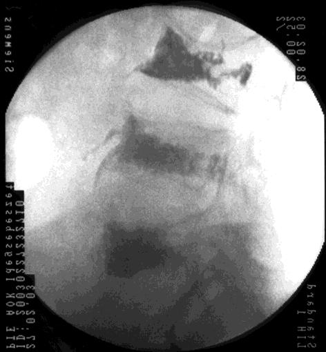 Vertebroplastica alkalmazási területei poroticus csigolya kompresszió
