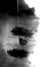 Extrusio epiduralis vénás