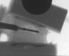 Vertebral body stent - VBS magassági korrekció