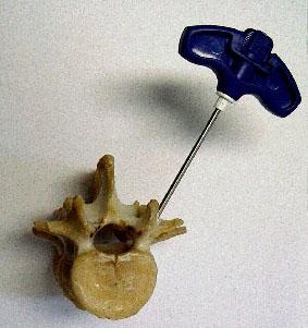 Percutan vertebroplastica (VP) (polymethyl methacrylate PMMA; Palacos)