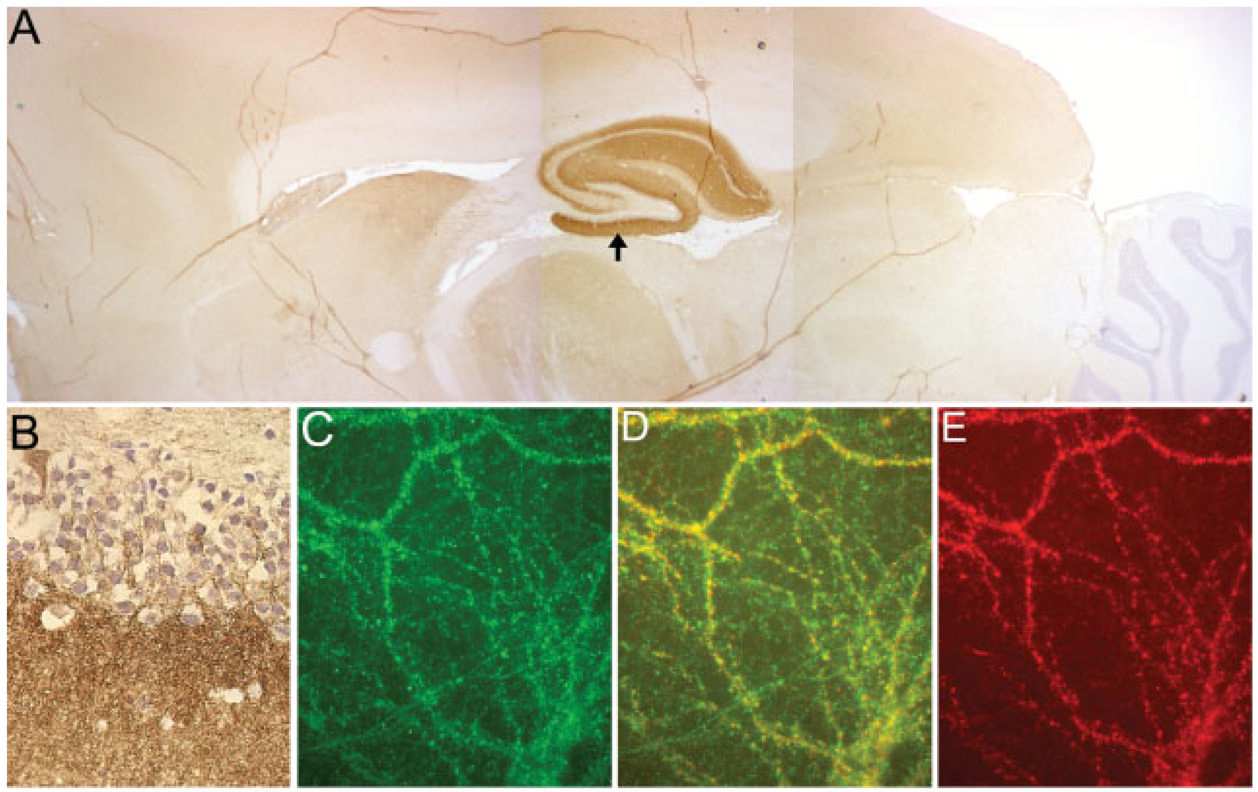 Limbicus encephalitis