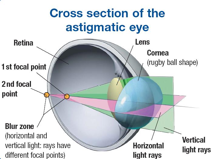 Az asztigmiás szem keresztmetszete Corneális asztigmia Ideghártya 1. gyújtópont 2.