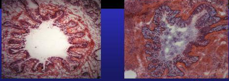 gyulladás bronchiectasia Egészséges és Cf-es bronchus A leggyakoribb gén mutációk Delta F 508 66,0 % G542X 2,4 % (spanyol) G551D