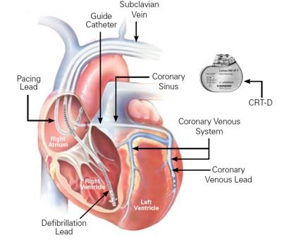 CRT CRT-D CÉL: a kardiális disszinkrónia (atrio-ventricularis, interventricularis, intraventricularis) megszüntetése, csökkentése HATÁSA: javul a szív teljesítménye, a 6