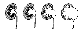 PYELOURETERALIS STENOSIS