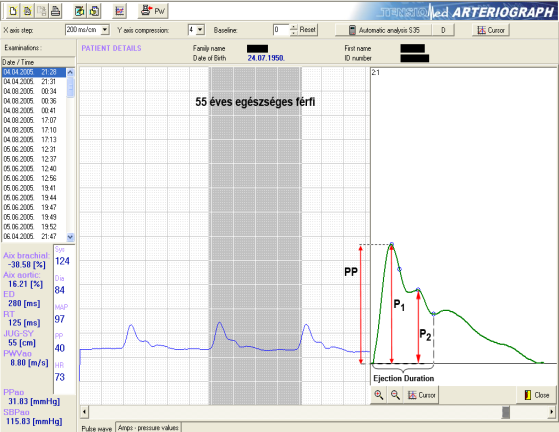 P1; az elsődleges pulzusnyomás hullám-, P2; a szekunder, reflektált pulzusnyomás hullám amplitúdója (Hgmm), PP; pulzusnyomás.