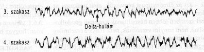3. kisebb delta hullámok: alvási orsók között 0.5-3Hz hullámok 4. nagy delta hullámok: 0.2-1Hz aktivitás A 3. és 4.
