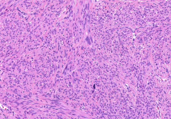 Kulka J és munkatársa állomány választja el egymástól. Meglepô módon nem annyira sejtdús, és a sejtosztódások száma is kisebb, mint a szokványos leiomyosarcoma esetében.