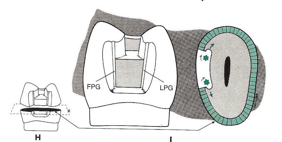 Befejező (sekunder) preparáció Másodlagos retencios elemek preparálása retenciós barázda (proximal grooves) a proximalis üregben