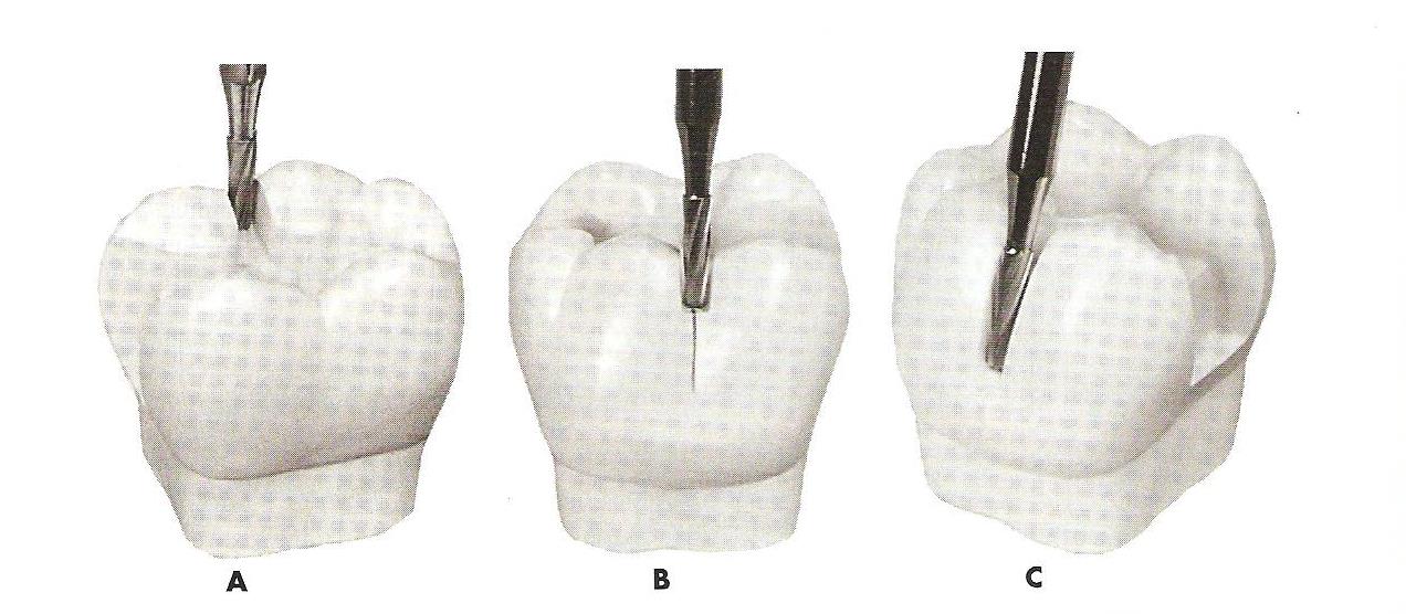 Vestibularis/oralis irányba hajlóbarázda A barázda méretének megfelelő árkot alakítunk ki az occlusiós