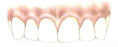 Interdentális papilla (ínyszemölcs) Háromszögletű ínyrész, amely kitölti a fogak közötti hézagot A fogak gingiva marginalisai legmélyebb pontján átfektetett horizontális