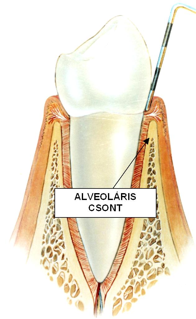 1. Alveoláris csont (lamina compacta, belső corticalis,