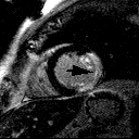 50 éves I, avl, ST eleváció Cx occlúzió - PCI Csúcs CK: 5912; MB: 792 Q AMI MRI: