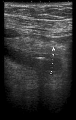 Acut appendicitis - Alvarado score Hasi UH