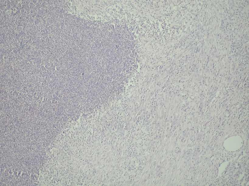 Peribronchiolaris gyulladás, tüdı, PCV-2 IHC Vírusantigén a nyiroktüszıkben, nyirokcsomó, PCV-2 IHC Gócos / multiplex gócos Fertızıdés útja hematogén ( emboliás ) aerogén (broncho következménye)
