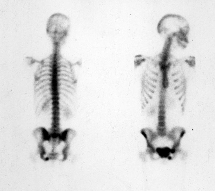 Csontszcintigráfia Betegbe bevitt radioaktív