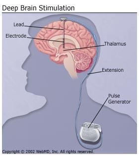 Reaktív gliózis mikroelektród körüli gliareakció Potter, Capadona 2012 Deep Brain Stimulation (DBS) 'a pacemaker for the brain gliareakció talamuszba épített